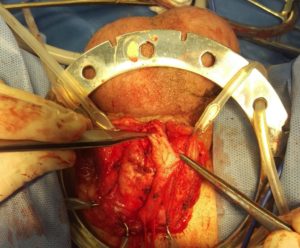 Uretroplastia 1