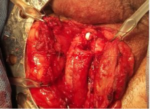 Uretroplastia 4