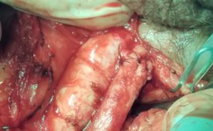 Uretroplastia 5