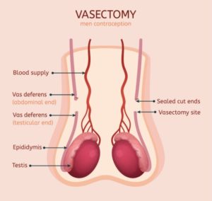 Vasectomia Vasos