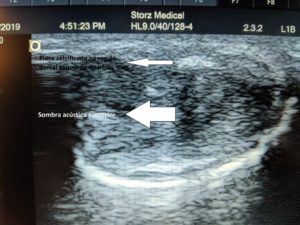 varicoza pelvis mica pe ultrasunete