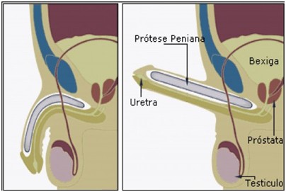 prótese peniana