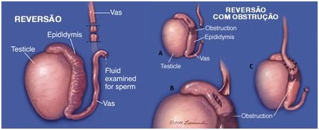 reversão vasectomia